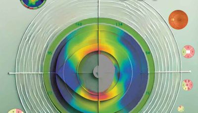 OCT در گلوکوم